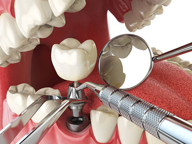 Best Emergency Treatment for Toothache in Lexico, CA